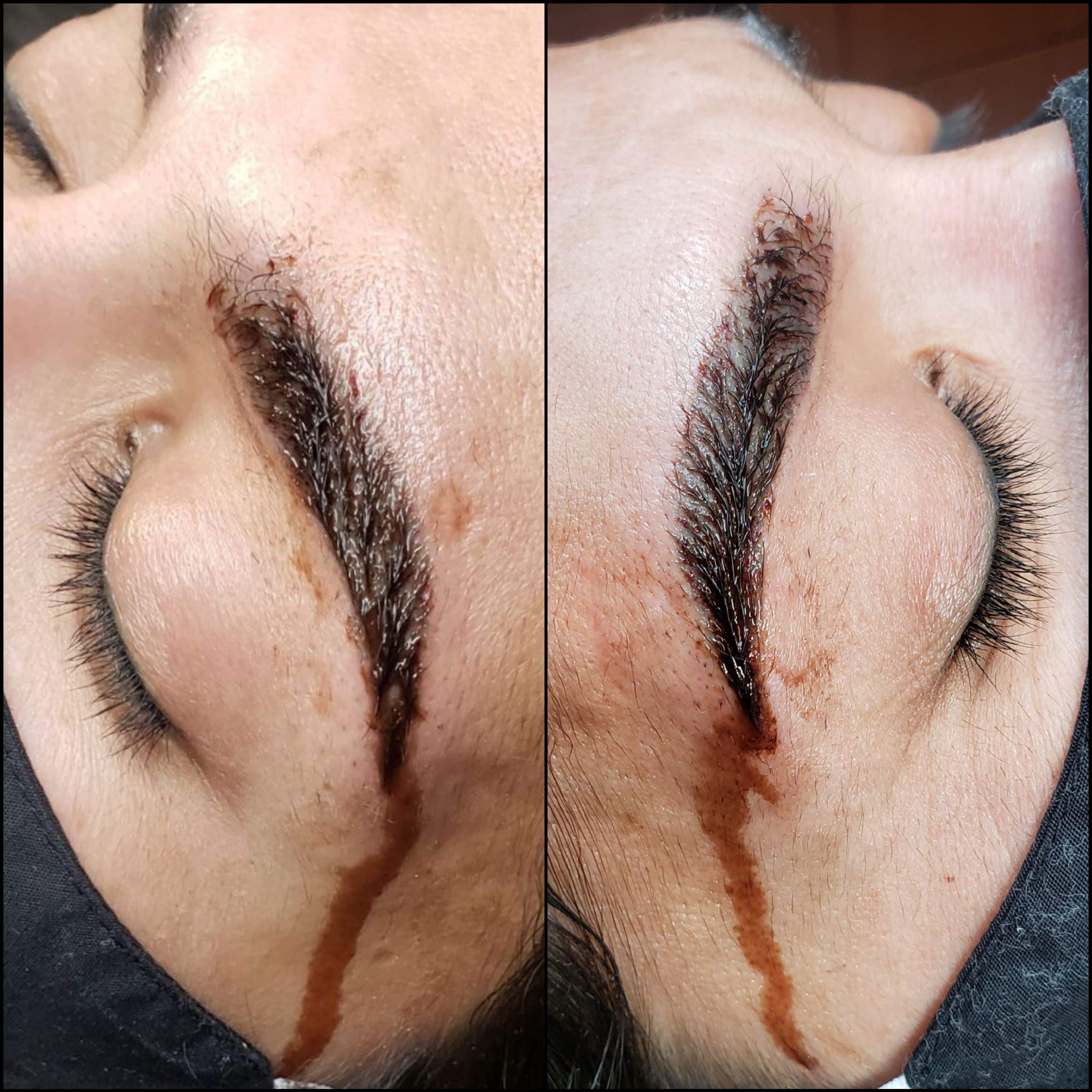 Microblading Removal in Houston  Tattoo Removal  Dermaluxe Spa